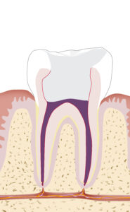 Zahnwurzelbehandlung, Endodontie, Wurzelfüllung